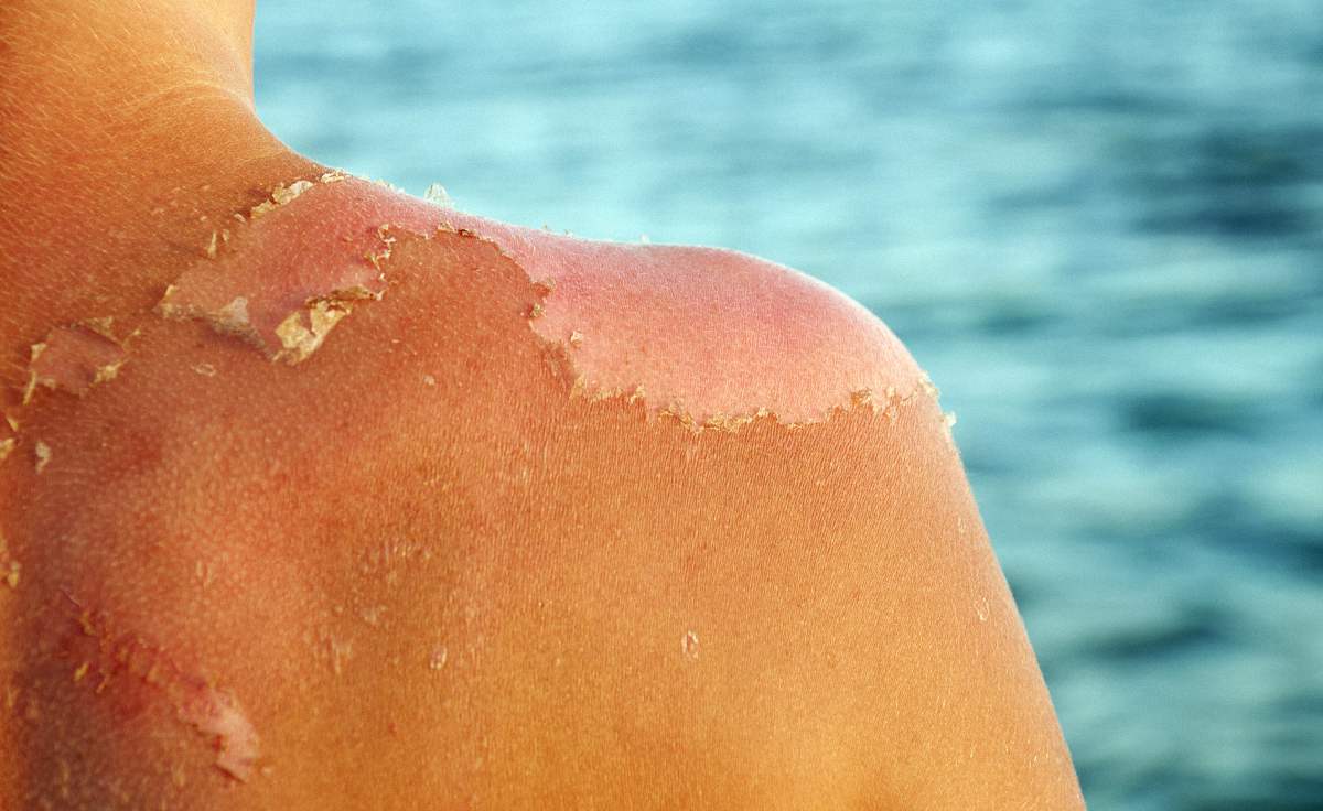 Dermatitis solaris, better known as common sunburn